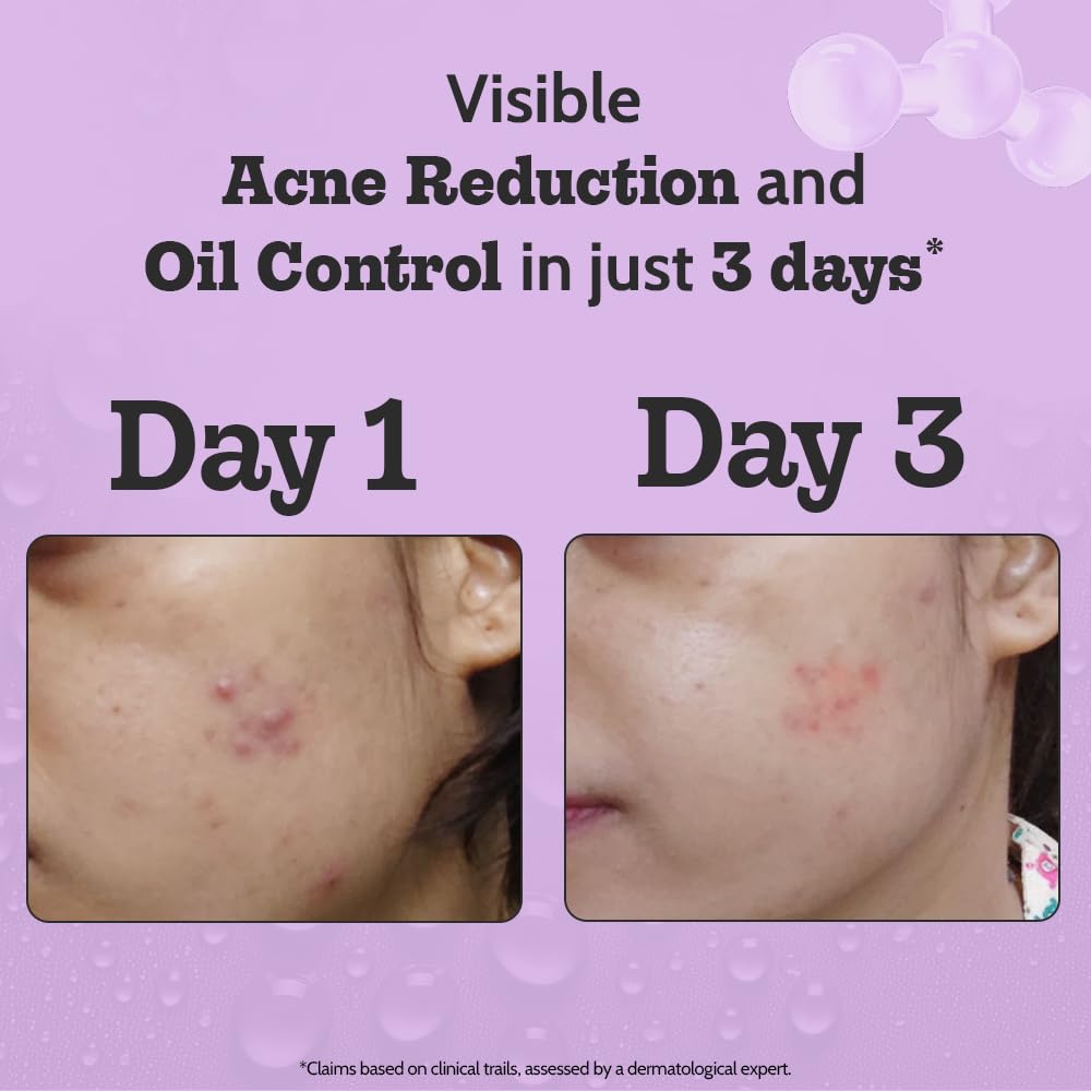 Chemist At Play 2% Salicylic Acid Face Serum | Treats Active Acne | Controls Excess Oil | Fades Acne Marks | Improves Skin Texture | 30ml