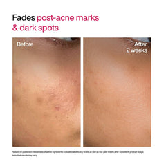 WishCare Advanced Dark Spot Correcting Serum - Niacinamide TXA Shot | 10% Niacinamide Face Serum For Pigmentation and Dark Spot | With 2% Alpha Arbutin & TXA for Glowing Skin | 10ml