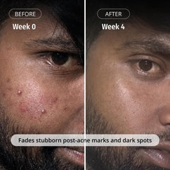 Vilvah Milk Drops Brightening Serum | Fades Dark Spots, Treats Hyperpigmentation & Evens Skin Tone | Hyaluronic Acid & Alpha Arbutin Serum for Women & Men | Suitable for All Skin Types | 20ml