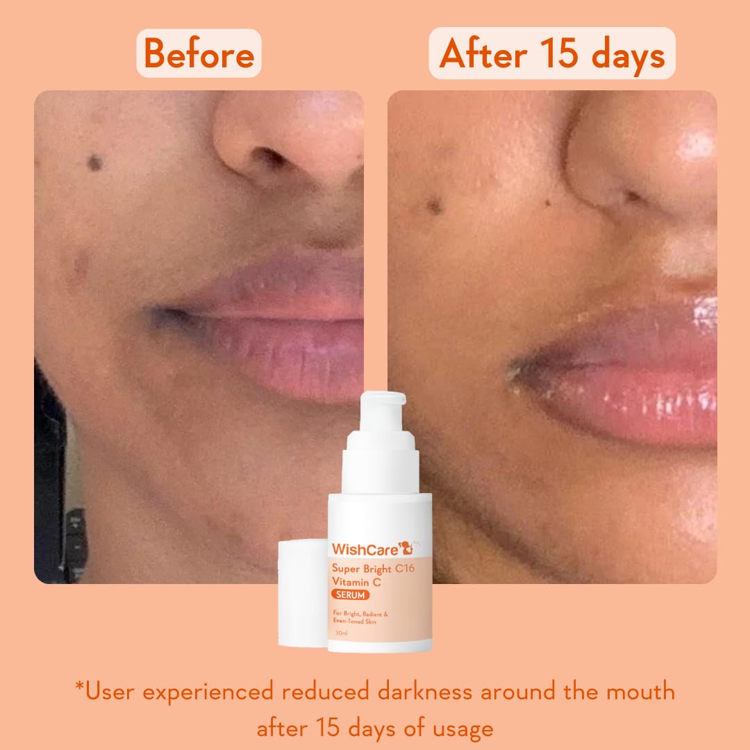 WishCare Super Bright C16 Vitamin C Serum For Oily Skin,Dry & Combination Skin -10% Vitamin C,4% Niacinamide,1% Kojic Acid,0.5% Ferulic Acid,Licorice & 4-N-BR- Serum For Pigmentation & Dark Spots 30Ml