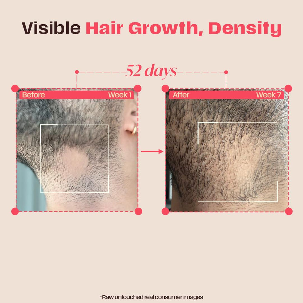 Days Ahead Leave-in Hair Growth Ampoule Serum (Roll on) | 16% Growth Actives | PDRN, Redensyl, Anagain | Hair Growth Serum | Promotes Growth, Increases Density | Non-Greasy | For Women & Men | 25 ml | Glammy.lk