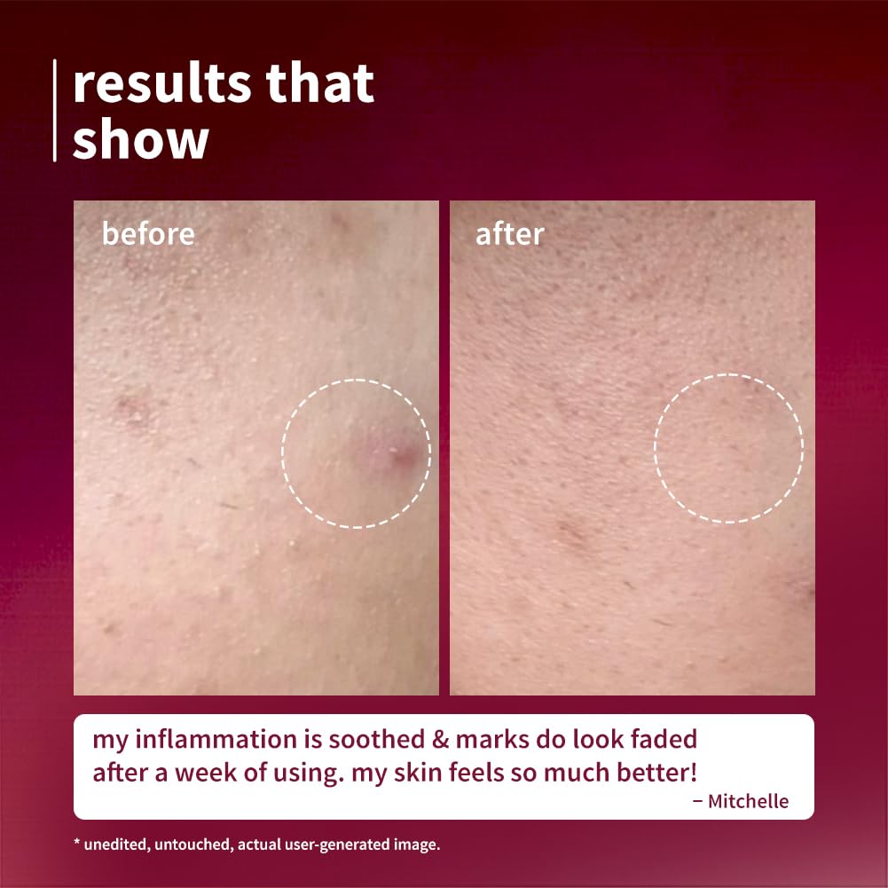 Plum Black Rice & Niacinamide-TXA 10% Night Clarity Jelly Serum | visibly reduce dark spots, stubborn acne marks, and improve overall skin clarity| 10ml