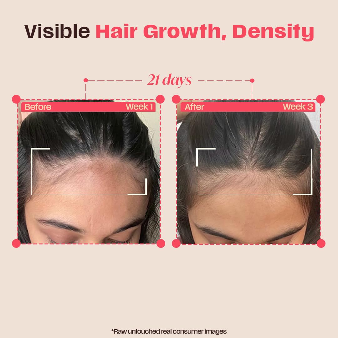Days Ahead Leave-in Hair Growth Ampoule Serum (Roll on) | 16% Growth Actives | PDRN, Redensyl, Anagain | Hair Growth Serum | Promotes Growth, Increases Density | Non-Greasy | For Women & Men | 25 ml | Glammy.lk