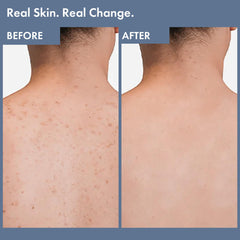 Thriveco Exfoliating Body Wash | Prevents Body Acne, Tan & Dead Skin Removal | With Lactic, Salicylic Acid, Vitamin E & Diacnemide® | Daily Use Shower Gel | For Men & Women | 236ml