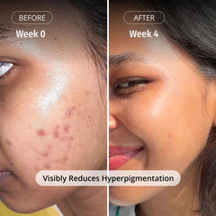 Vilvah Milk Drops Brightening Serum | Fades Dark Spots, Treats Hyperpigmentation & Evens Skin Tone | Hyaluronic Acid & Alpha Arbutin Serum for Women & Men | Suitable for All Skin Types | 20ml
