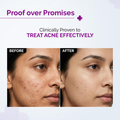 The Derma Co 2% Salicylic Acid Face Serum | Reduces acne & blackheads | Tightens pores | Exfoliates & soothes inflammation | 30 ml