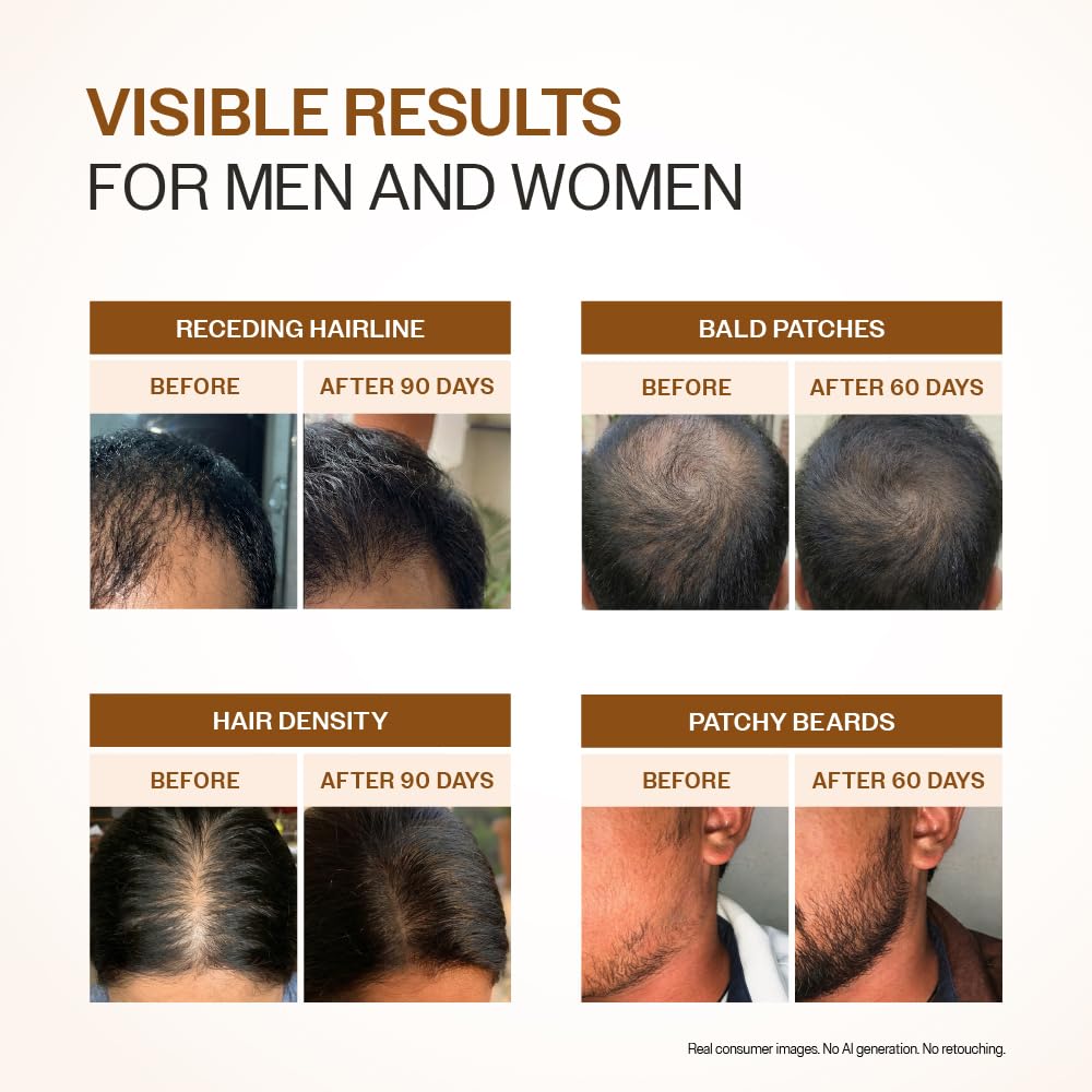 Bare Anatomy Advanced Hair Growth Serum | 3% Redensyl, 4% Anagain, 3% Baicapil, 1% Capilia Longa, Rosemary, Biotin & Rice Extract | Hairfall control & Hair Density | Women & Men | 30ml
