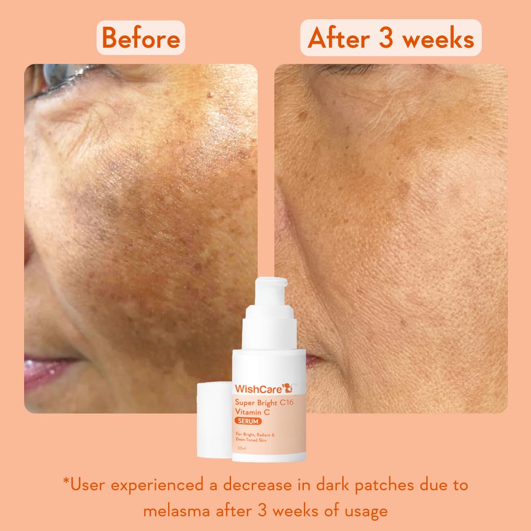WishCare Super Bright C16 Vitamin C Serum For Oily Skin,Dry & Combination Skin -10% Vitamin C,4% Niacinamide,1% Kojic Acid,0.5% Ferulic Acid,Licorice & 4-N-BR- Serum For Pigmentation & Dark Spots 30Ml