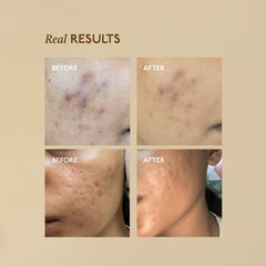 Asaya Advanced Spot Pigmentation Face Serum | Reduces Dark Spots, Melasma, Acne Marks & Hyperpigmentation | MelaMe™ Complex, Niacinamide & Alpha Arbutin | Evens Skin Tone & Brightens Dull Skin