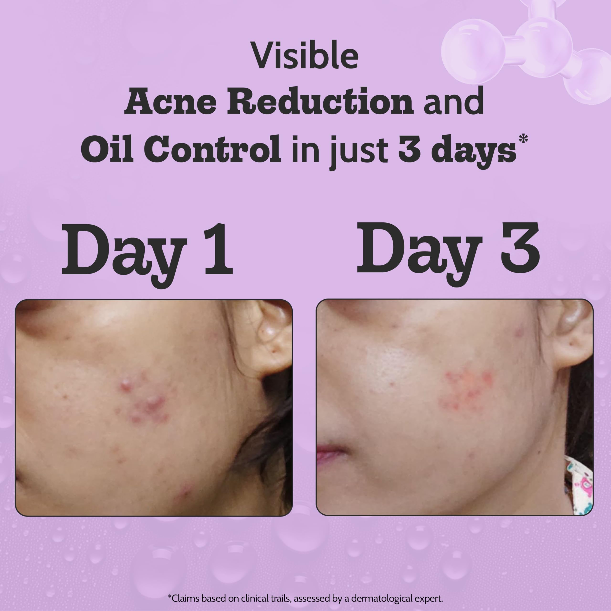 Chemist At Play 2% Salicylic Acid Face Serum | Treats Active Acne | Controls Excess Oil | Fades Acne Marks | Improves Skin Texture | 30ml