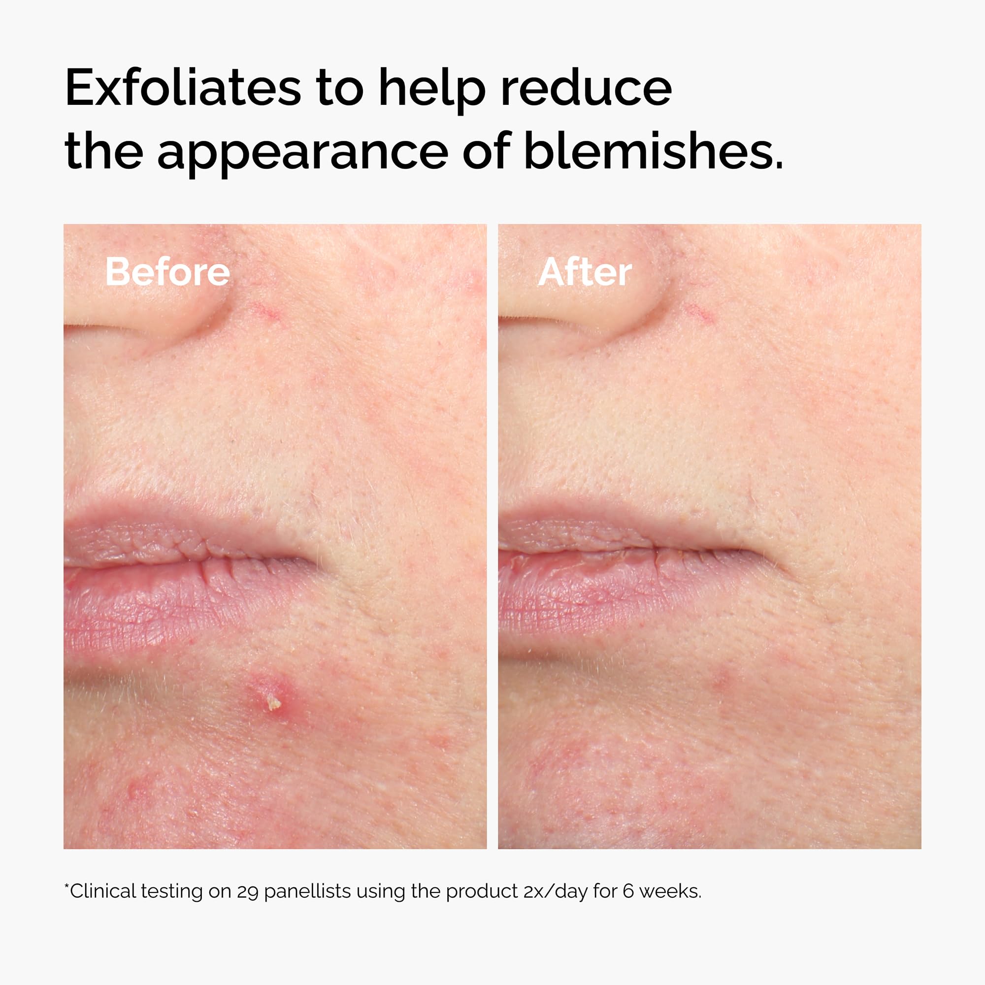 The Ordinary Salicylic Acid 2% Solution, Targeted Serum for Blemish-Prone Skin, 30ml