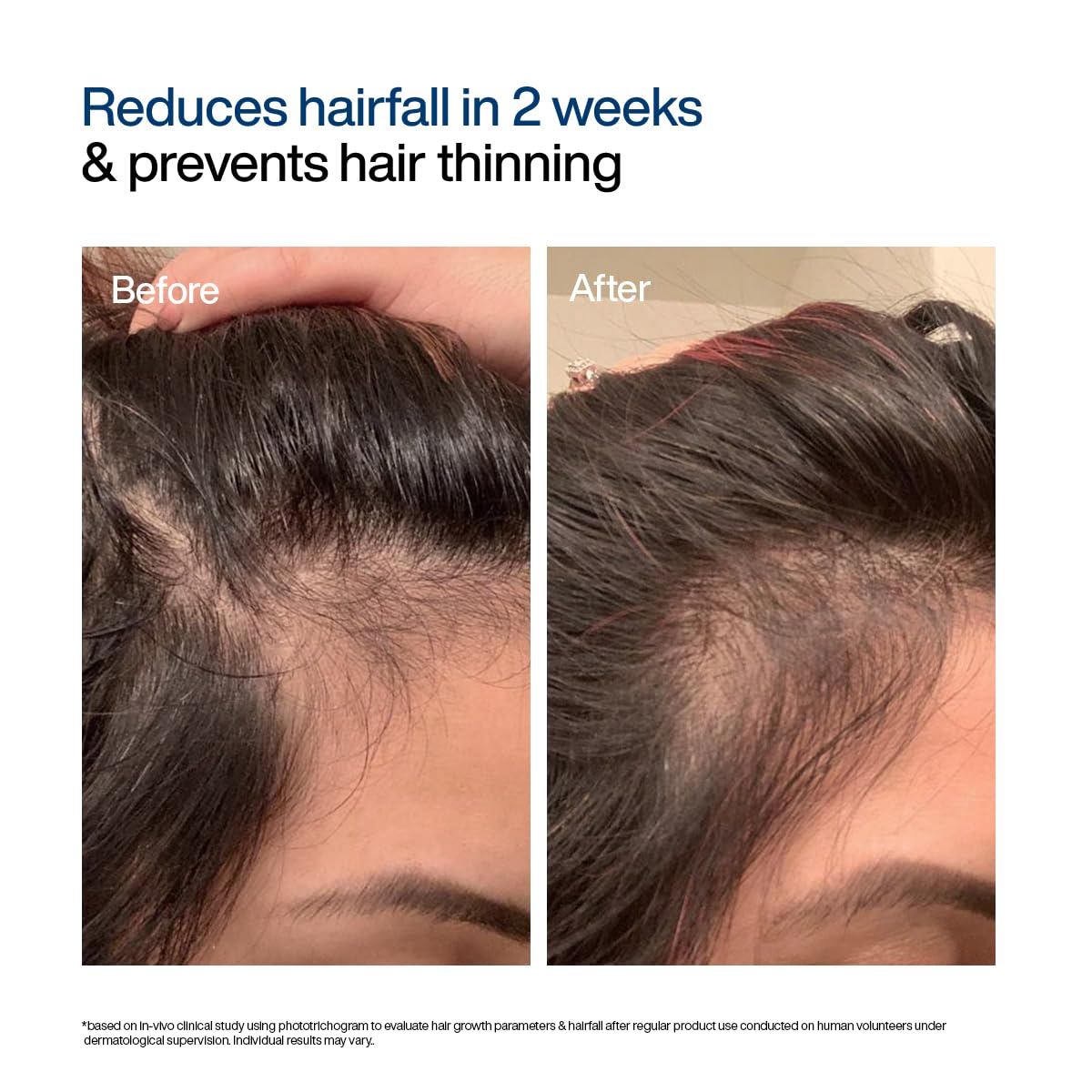 WishCare Hair Growth Serum For Scalp | 94% Saw New Hair Growth | Redensyl & Rosemary Oil | 100% Saw Hairfall Reduction | In-Vivo Tested | For Men & Women | 30ml | Glammy.lk