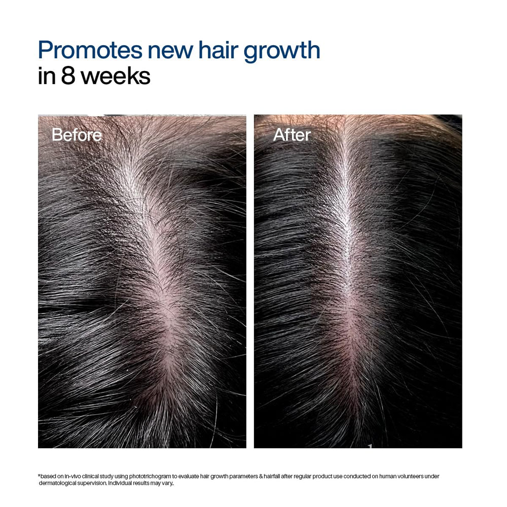 WishCare Hair Growth Serum For Scalp | 94% Saw New Hair Growth | Redensyl & Rosemary Oil | 100% Saw Hairfall Reduction | In-Vivo Tested | For Men & Women | 30ml | Glammy.lk
