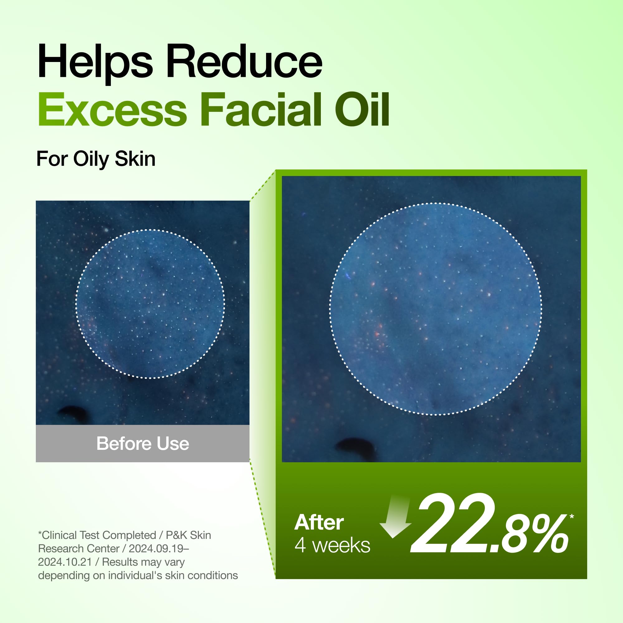 Anua Azelaic Acid 10 Hyaluron Redness Soothing Serum with Cica Soothes & Calms Acne-Prone Skin