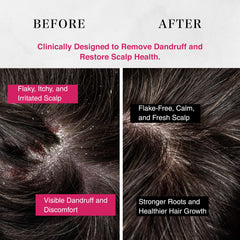 Suzyan Professional Dandruff Scalp Scrub | Exfoliates Dead Skin & Reduces Flakes | Soothes Itchy Scalp | Sulfate & Paraben Free | Suitable for All Hair Types – 200g